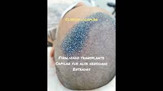 Aparência real e imediata após transplante capilar #fue #altadensidade colocação DNI #hairtransplant