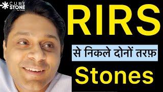 गुर्दे की पथरी का इलाज | RIRS से निकले दोनों तरफ के Kidney stone | RIRS Patient Testimonial#rirs