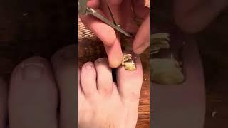 INFECTED TOENAIL REMOVAL AT HOME