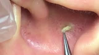 Удаление комедона из ушной раковины | Removing comedones from the auricle