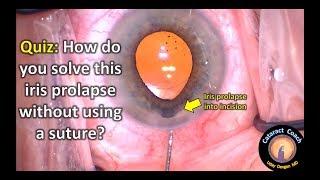Quiz: How to fix iris prolapse at the incision in Cataract Surgery