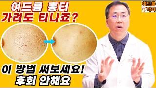 여드름 흉터️가려도 티나죠이 방법 써보세요️후회 안해요 #여드름흉터 #여드름흉터없애는법 #여드름흉터없애는방법