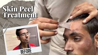 Instant Skin Glow & Whitening? Vitamin C Peeling Tested! (SHOCKING RESULTS!) | Mridul Madhok