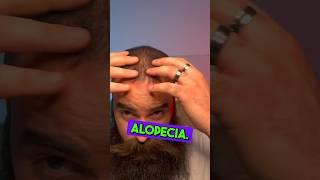 TRATTAMENTO ALOPECIA / ALOPECIA TREATMENT #alopecia #alopeciahairloss #calvizie #hairloss #capelli