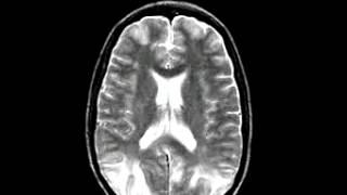 Cerebrovascular Disease Hypertensive encephalopathy27