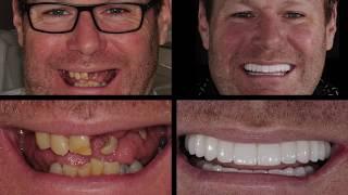 For Mike, having a new smile is everything. Follow the journey to his new smile!