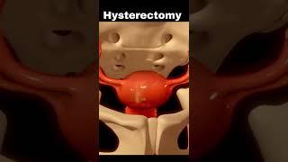 Hysterectomy ||Removal of uterus #shorts