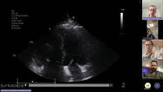 Echo in pulmonary hypertension and consequences to RV PA coupling