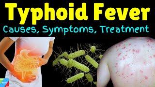 Typhoid Fever: Causes, Symptoms, Pathogenesis, Diagnosis, Treatment, Prevention and Vaccine