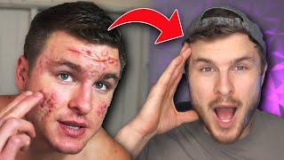 Eliminate Acne Marks & Scarring (FROM EXPERIENCE) | BEST INGREDIENTS IN EXISTENCE!