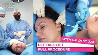 "Point of Elevation of Tissue: Face Lift" (full procedure)  - CG Cosmetic Surgery