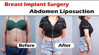 Breast Implant Surgery & Abdomen Liposuction result