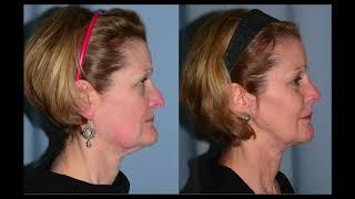 Jaw surgery. TMJ. Access & approach. Facelift