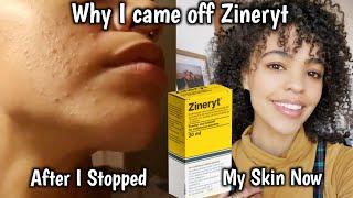 Why I Came Off Zineryt | Did My Acne Come Back?