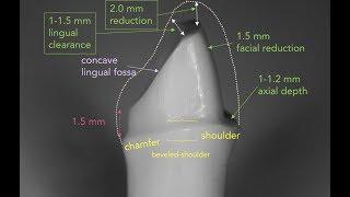 Anterior PFM Preparation | Dr. Richard Stevenson