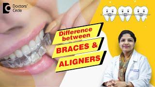 Aligners vs Braces Treatment - Which is the Best? - Dr. Divyashree Rajendra | Doctors' Circle