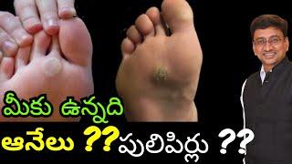 Anekayala - Pulipirikayala ? #wartstreatment #corntreatment #homeopathicmedicine