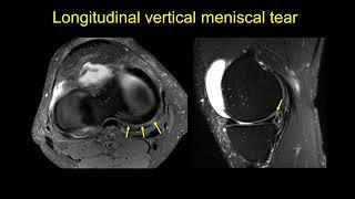 Imaging of the menisci