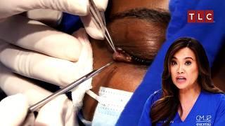 Tackling the Toughest Surgery Yet! | Dr Pimple Popper TLC