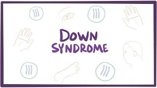 Down syndrome (Trisomy 21) - causes, symptoms, diagnosis, & pathology (Updated 2024)