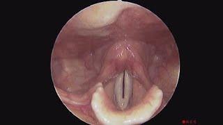 The Normal Vocal Cord with Visible Tracheal Lumen