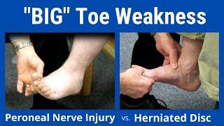 Big Toe Weakness: Peroneal Nerve Palsy vs. L5 Nerve Root Compression