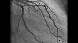 Coronary Angiography | NEJM