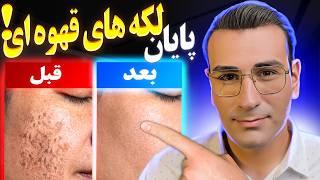 درمان سریع لکه های قهوه ای و لکه های پیری! پوستی روشن و صاف داشته باش! | Say Goodbye To Dark Spots