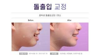 [청소년 치아교정] 돌출입교정(중학생 돌출입교정/덧니) Before&After :: 초등학생/중학생/고등학생 치아교정 - 부산해운대 장산역 뉴욕스마일 치과교정과 치과의원