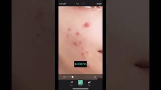 how to remove pimples by picsart/picsart editing/marks removing/easy methode/malayalam/Tastydip