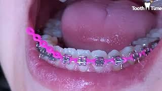 Braces checkups - Power chains - 16 months with braces - Tooth Time Family Dentistry