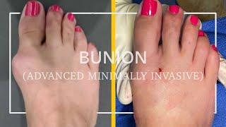 Say Goodbye to Foot Pain Forever: Before and After Bunion Procedure