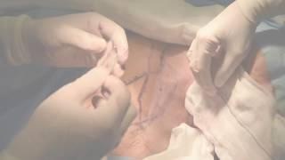 Supraclavicular Artery Skin Island Flap