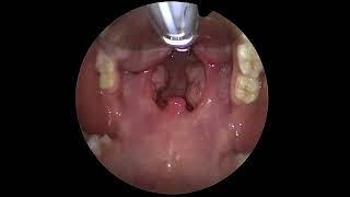 The Throat Exposure For Tonsillectomy Surgery