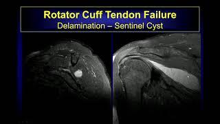 Imaging findings of Rotator cuff