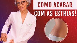 Estrias: o que são, prevenção e como combater!