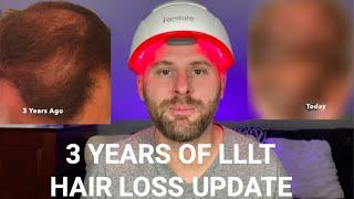 3 Years Of Using Low Level Laser Therapy (LLLT) For Hair Loss - My Results.