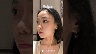 최애가 되... #안면윤곽 #안면거상 #코수술 #코성형 #이마 #성형후기 #성형전후