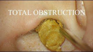 TOTAL OBSTRUCTION : EAR WAX REMOVAL : 4K/HD