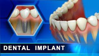 Dental Implant in Advanced procedure in 3d animation by Curveia