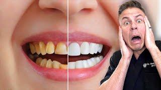 How You Are Whitening Your Teeth The WRONG Way!