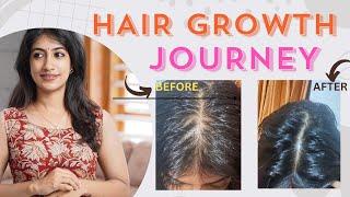 My Hair Growth Journey | Minoxidil | Female pattern Hair Loss