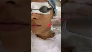 Depigmenting Laser Facial