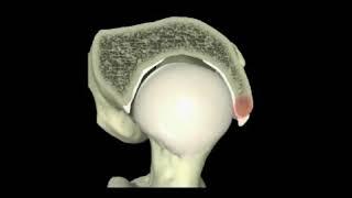 Pincer Impingement Animation | Pincer Pathology | Nashville Hip Institute