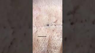 Firefighter Blackheads ‍ | Dr. Pimple Popper #drpimplepopper #shorts #pimple #blackheads