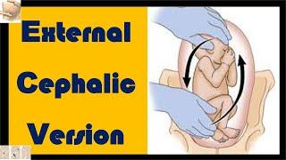 External Cephalic Version (ECV)  | How to Flip a Fetus? | How to Turn a Breech Baby?