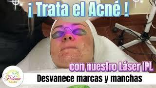 Acné Láser IPL - Paloma Clinic Spa - TX