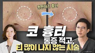 코 흉터 없애기 by 도트필, 미라젯, 쥬베룩 치료