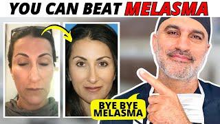 How Dr. Amir Karam treated his wife's Melasma AT HOME! Step by Step!