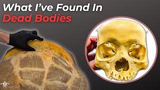 Insane Things I've Found In Dead Bodies